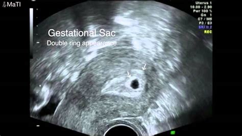 5 haftalık gebelik görüntüleri ultrason